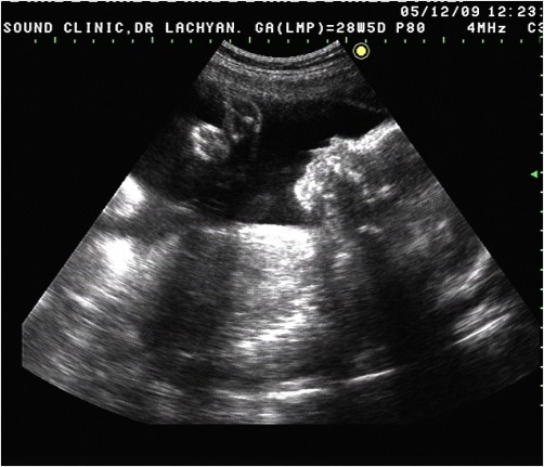 7th Month Baby in Mother's Womb